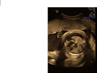 Hydrothorax axial chest